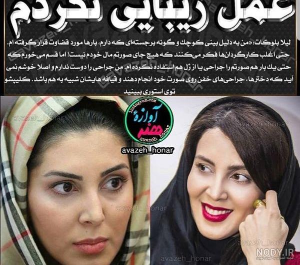 بررسی عمل زیبایی بازیگران + عکس قبل و بعد از عمل
