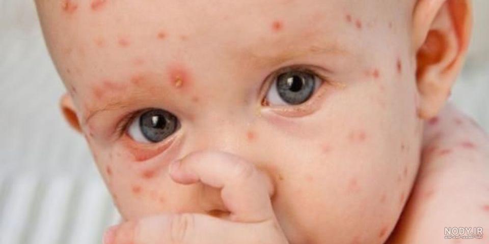 تاریخچه کامل از ویروس آبله میمون