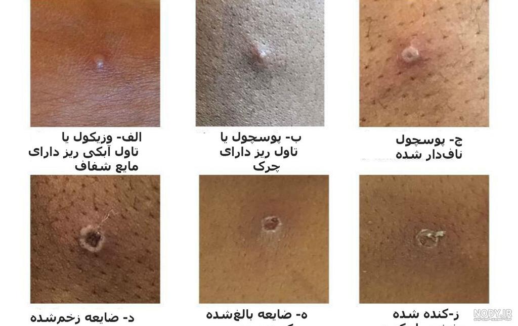 عکس آبله میمون و تفاوت با دیگر زخم ها - وبلاگ فروشگاه رپید تست