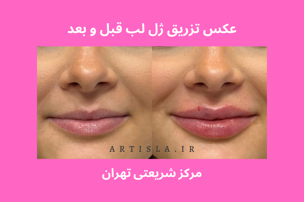 عکس رژ لب ژله ای