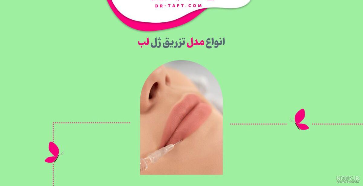مدل های مختلف تزریق ژل لب - تزریق ژل و بوتاکس در کرج-بوتاکس-تزریق ژل