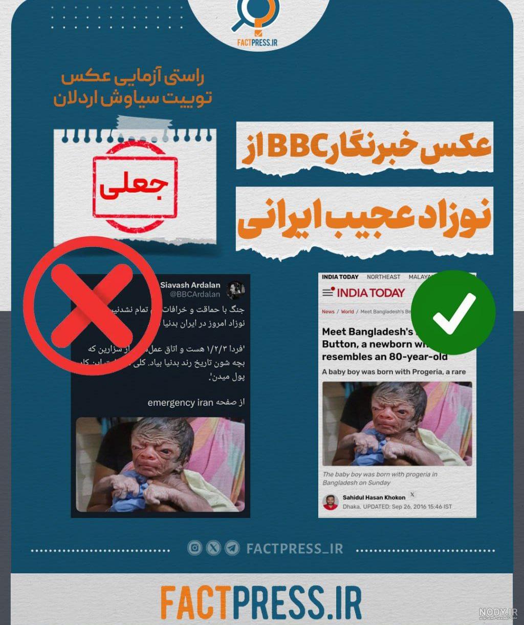 تولد یک نوزاد عجیب‌الخلقه در هند +عکس