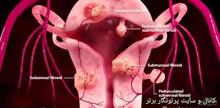 بستن لوله های رحمی (توبکتومی) - مجله پزشکی ماماچه