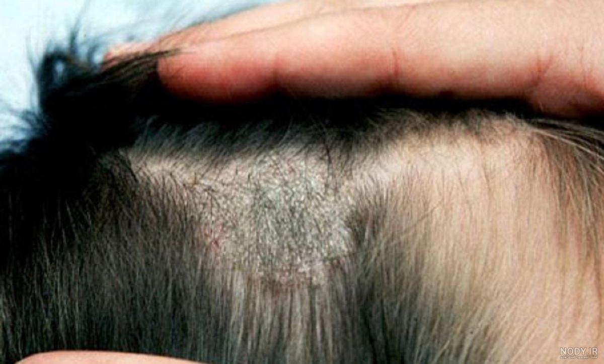 عفونت های پوستی در ریزش مو: درماتیت سبورئیک | قوی ترین طلسمات+قویترین ... عفونت های پوستی در ریزش مو: درماتیت سبورئیک | قوی ترین طلسمات+قویترین ...