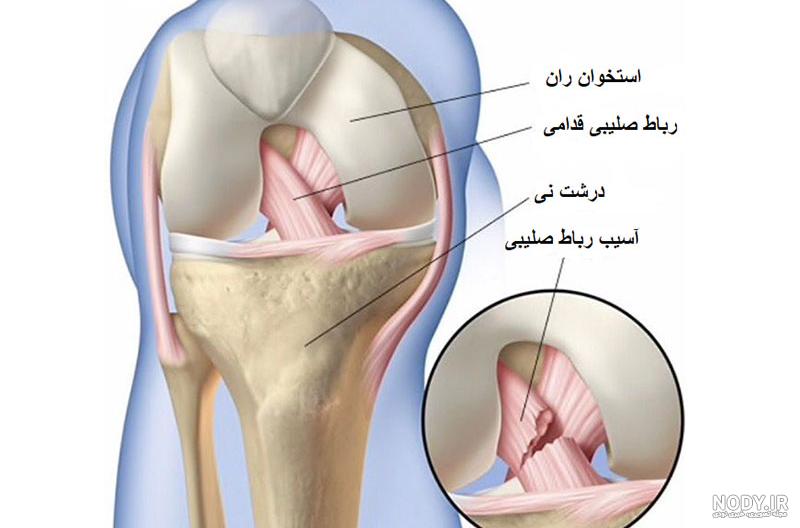 پارگی رباط صلیبی در فوتبال + عکس | دکتر رضا نادری