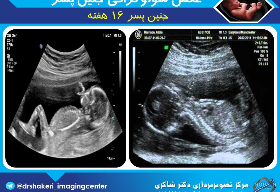 تعیین جنسیت (پسر، هفته 16) / مرکز تصویربرداری دکتر شاکری تعیین جنسیت (پسر، هفته 16) / مرکز تصویربرداری دکتر شاکری
