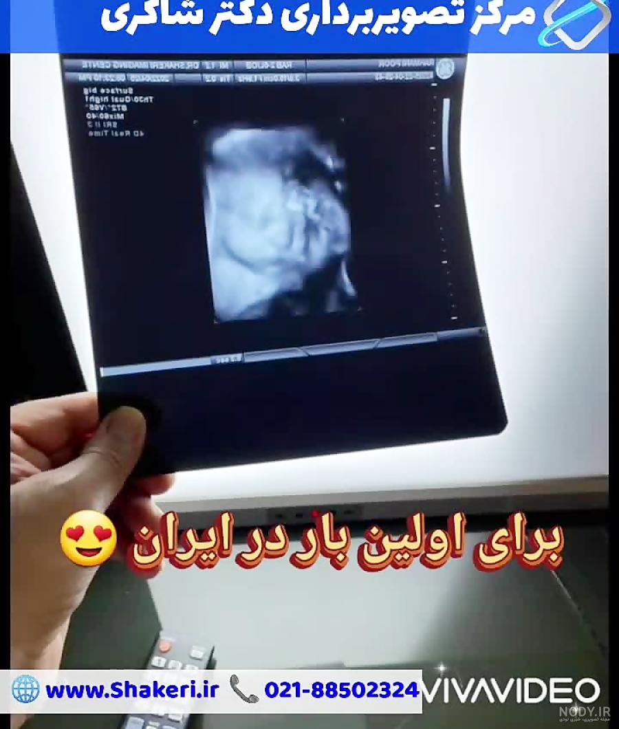 تعیین جنسیت (پسر، هفته 16) / مرکز تصویربرداری دکتر شاکری