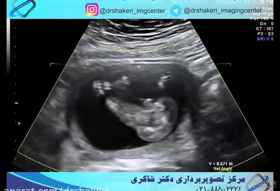 عکس سونوگرافی جنین پسر - مرکز تصویربرداری دکتر شاکری عکس سونوگرافی جنین پسر - مرکز تصویربرداری دکتر شاکری