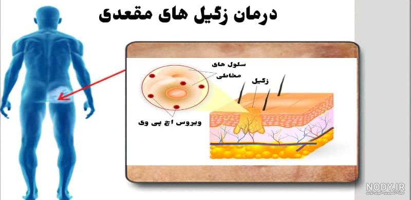 عکس زگیل تناسلی در مردان و زنان + علائم، پیشگیری و درمان