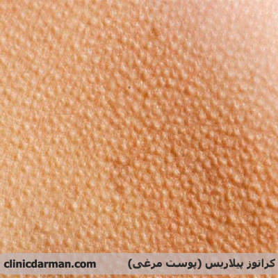 عکس ویروس اچ پی وی در زنان