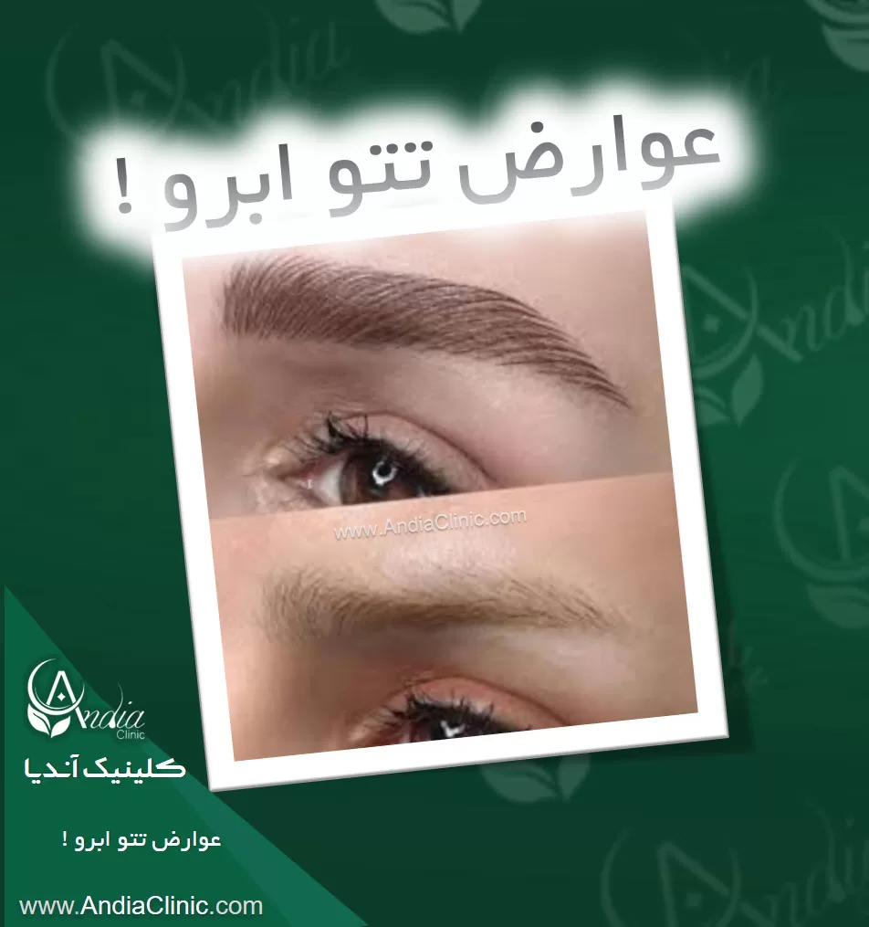 پاک کردن تاتو ابرو (Eyebrow Tattoo Removal) - مینا اکباتانی پاک کردن تاتو ابرو (Eyebrow Tattoo Removal) - مینا اکباتانی