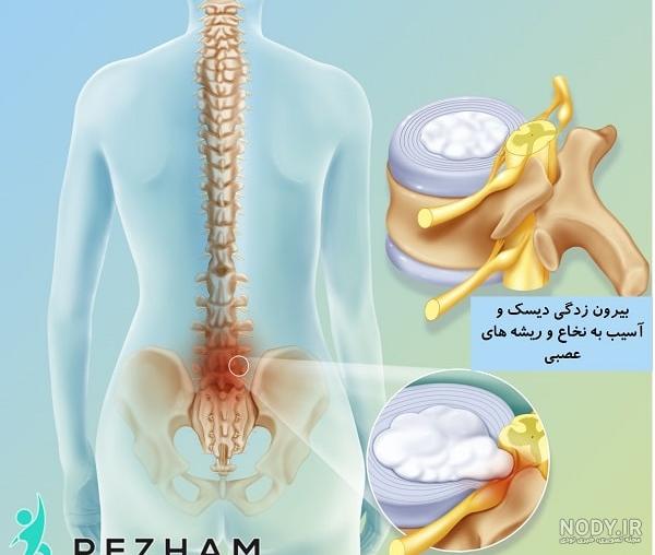 قیمت کمربند طبی دیسک کمر، سیاتیک، فنردار و آتل دار، نرم و سخت| طب پوش