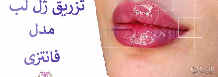 تصویر با کیفیت پروتز لب تصویر با کیفیت پروتز لب