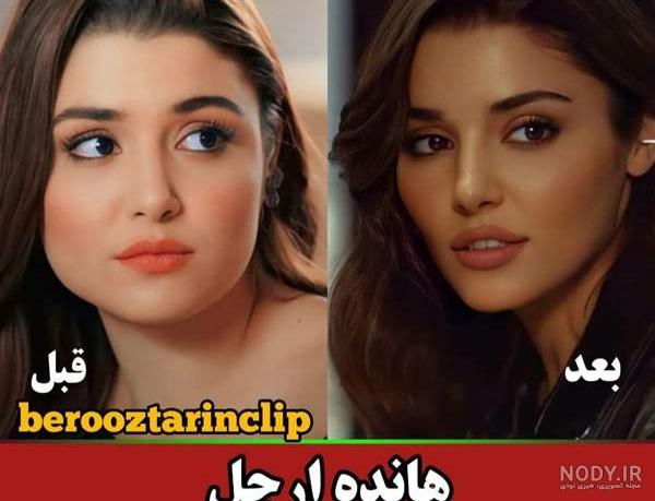 عکس جدید هانده ارچل بعد از عمل