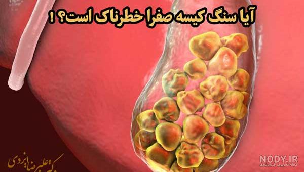 اين همه سنگ در كيسه صفرا/عکس اين همه سنگ در كيسه صفرا/عکس