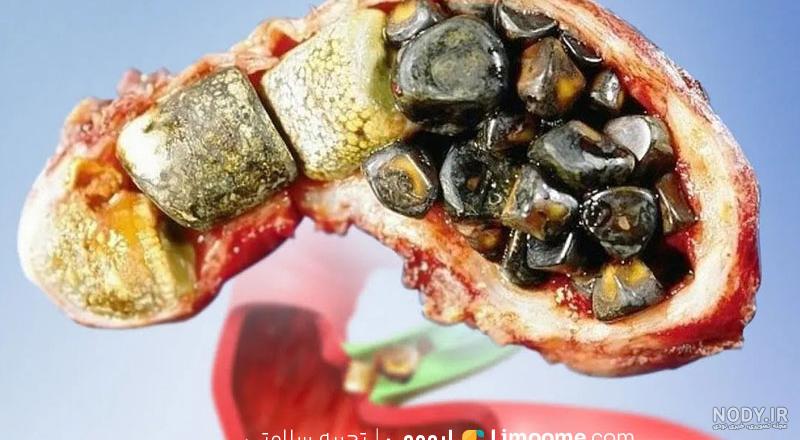 سنگ کیسه صفرا چیست و چه علائمی دارد؟ | مجله هومکا سنگ کیسه صفرا چیست و چه علائمی دارد؟ | مجله هومکا