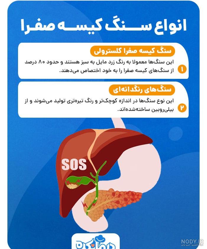 علائم "سنگ کیسه صفرا" چیست + راهکار درمانی طب سنتی - تسنیم علائم "سنگ کیسه صفرا" چیست + راهکار درمانی طب سنتی - تسنیم