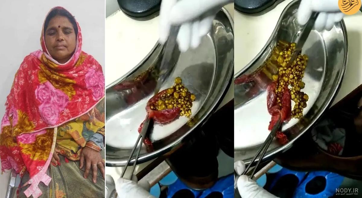 عکس سنگ صفرا دفع شده عکس سنگ صفرا دفع شده