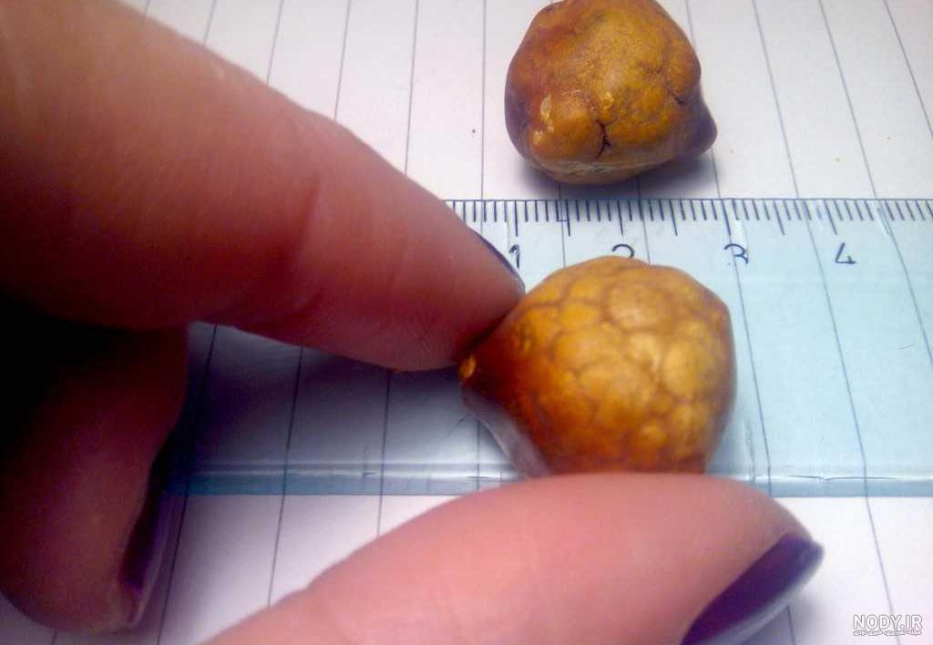 عکس سنگ کیسه صفرا عکس سنگ کیسه صفرا