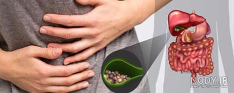 عکس سنگ کیسه صفرا چیست عکس سنگ کیسه صفرا چیست