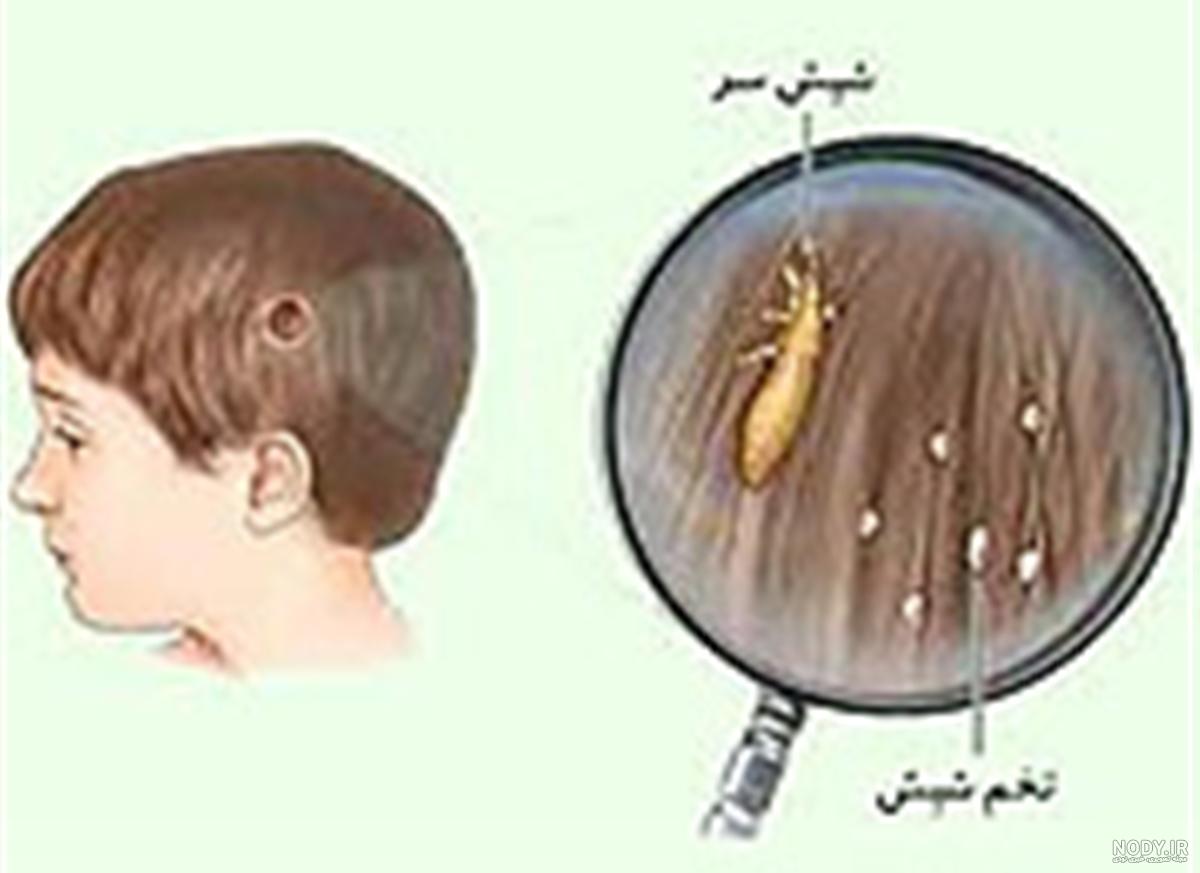 عکس شپش فیلم عکس شپش فیلم