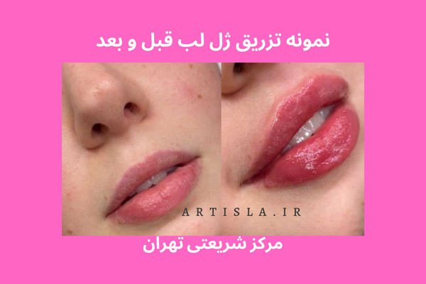 تب سنج دیجیتالی کودک نیو نی نی- ویتالوکس تب سنج دیجیتالی کودک نیو نی نی- ویتالوکس