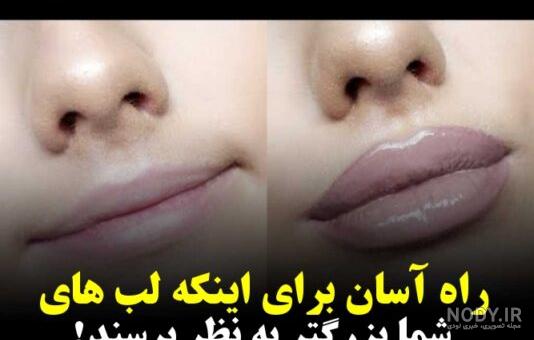 تزریق ژل لب فانتزی: قلبی، گرد، سوتی، قلوه ای، چاک دار — کلینیک پوست و مو لیا تزریق ژل لب فانتزی: قلبی، گرد، سوتی، قلوه ای، چاک دار — کلینیک پوست و مو لیا