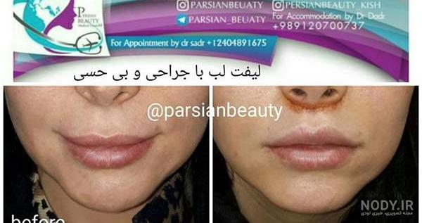 تزریق ژل لب نیم سی سی بالا و پایین کمه؟؟ صفحه 3 | تبادل نظر نی نی سایت تزریق ژل لب نیم سی سی بالا و پایین کمه؟؟ صفحه 3 | تبادل نظر نی نی سایت