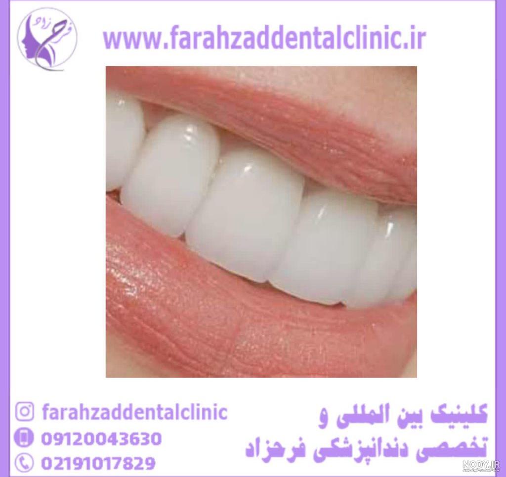 روش طبیعی سفید کردن دندان - دکتر بهمن پوراقدم روش طبیعی سفید کردن دندان - دکتر بهمن پوراقدم