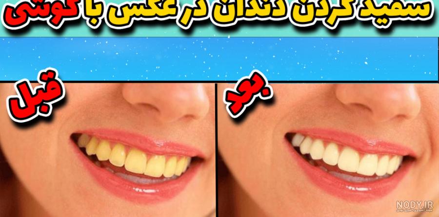 عکس دندان سفید عکس دندان سفید