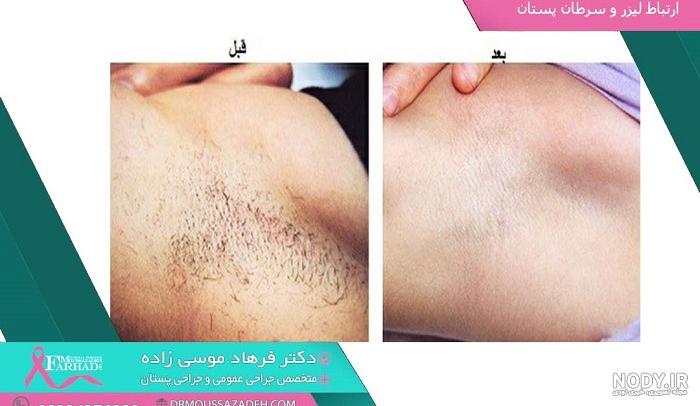 لیزر موهای زائد در خانم ها، فواید و عوارض | مجله نی نی سایت لیزر موهای زائد در خانم ها، فواید و عوارض | مجله نی نی سایت