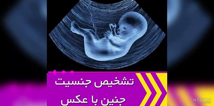 تفاوت جنین دختر و پسر در سونوگرافی هفته ۱۲