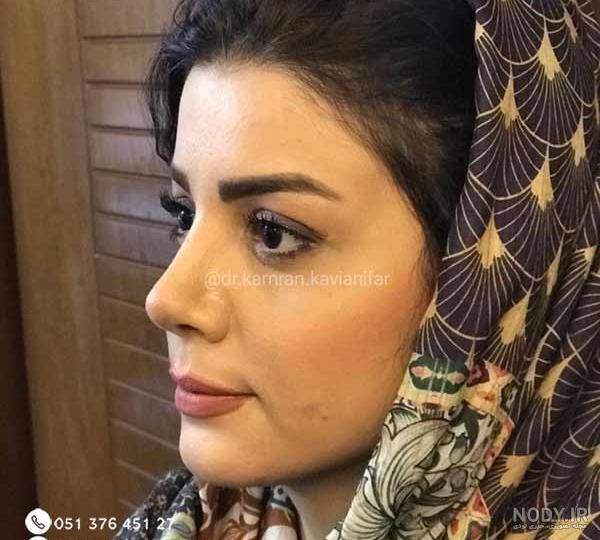 عکس دختر بعد از عمل بینی عکس دختر بعد از عمل بینی
