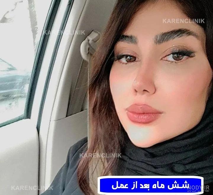 عکس دختر دماغ عملی زشت عکس دختر دماغ عملی زشت