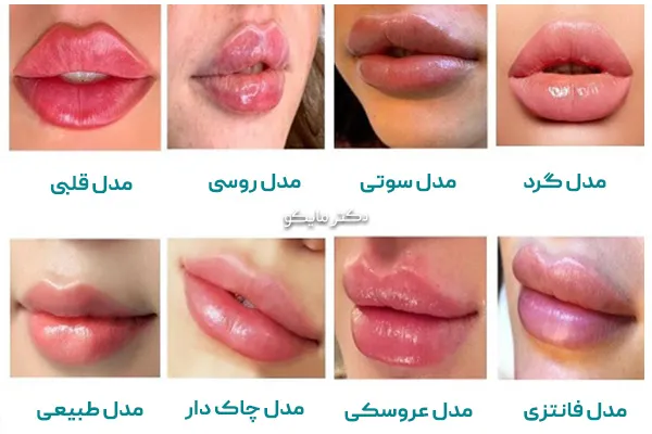 انواع مدل تزریق ژل لب ! عکس جدیدترین مدل ها - الهام الوندی انواع مدل تزریق ژل لب ! عکس جدیدترین مدل ها - الهام الوندی