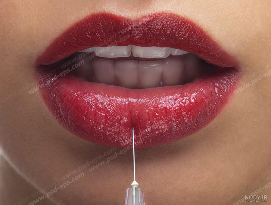 تزریق ژل لب - دکتر آزیتا مولازاده تزریق ژل لب - دکتر آزیتا مولازاده