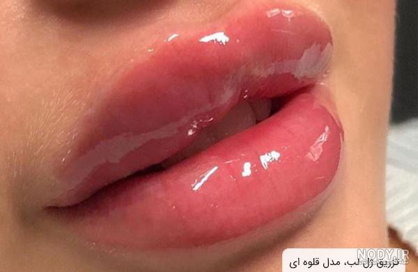تزریق ژل لب مدل روسی چگونه است؟ همه چیز در مورد آن تزریق ژل لب مدل روسی چگونه است؟ همه چیز در مورد آن