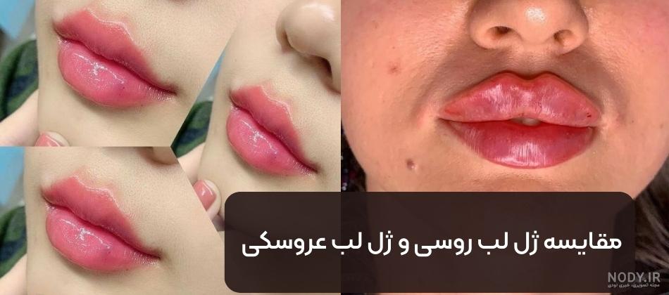 تزریق ژل لب مدل قلوه ای چیست؟ بررسی کامل عوارض و شرایط آن تزریق ژل لب مدل قلوه ای چیست؟ بررسی کامل عوارض و شرایط آن