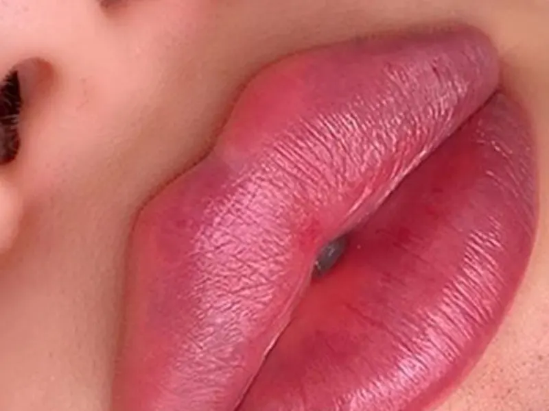 تصاویر قبل و بعد از تزریق ژل تصاویر قبل و بعد از تزریق ژل