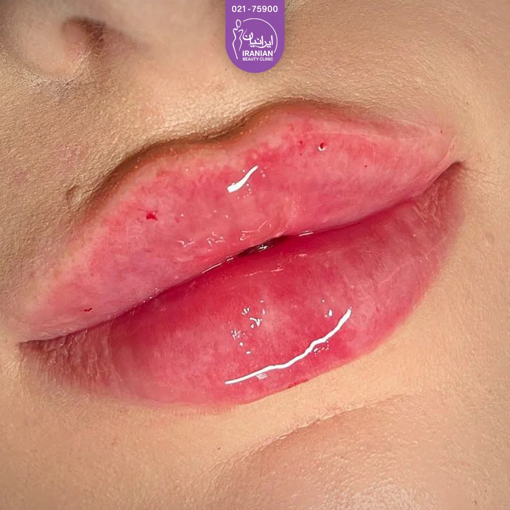 عکس تزریق ژل لب - 10 نکته مهم در تزریق ژل لب - گلوریا سنتر عکس تزریق ژل لب - 10 نکته مهم در تزریق ژل لب - گلوریا سنتر