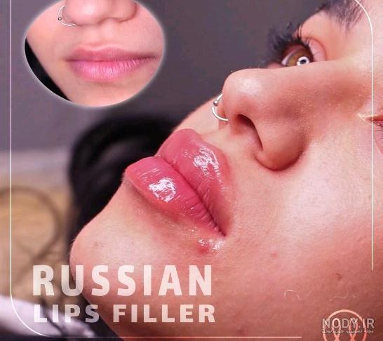 عکس لب ژل تزریق شده عکس لب ژل تزریق شده