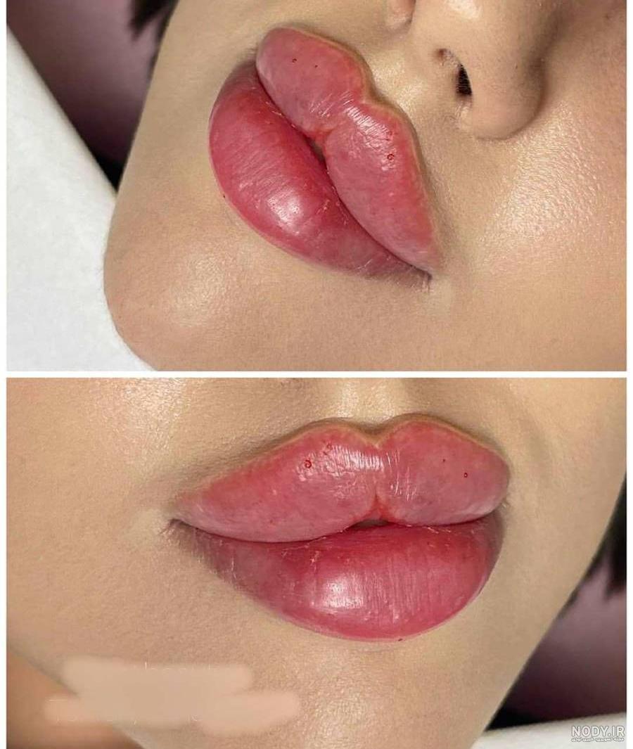 عکس لب ژل خورده عکس لب ژل خورده