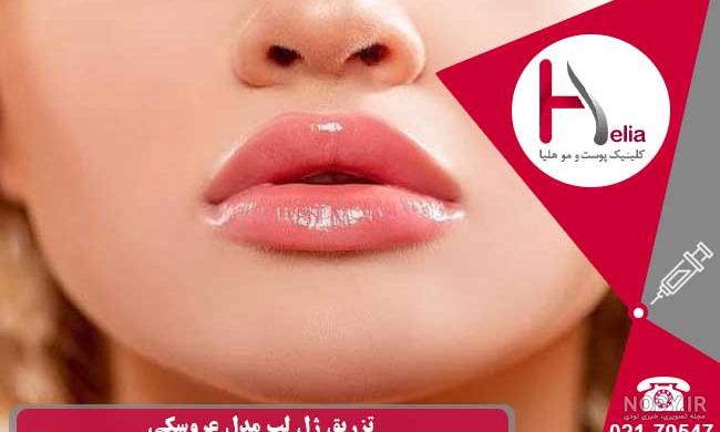 عکس لب ژل دار عکس لب ژل دار