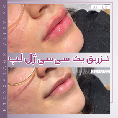 عکس لب ژل زده بزرگ عکس لب ژل زده بزرگ