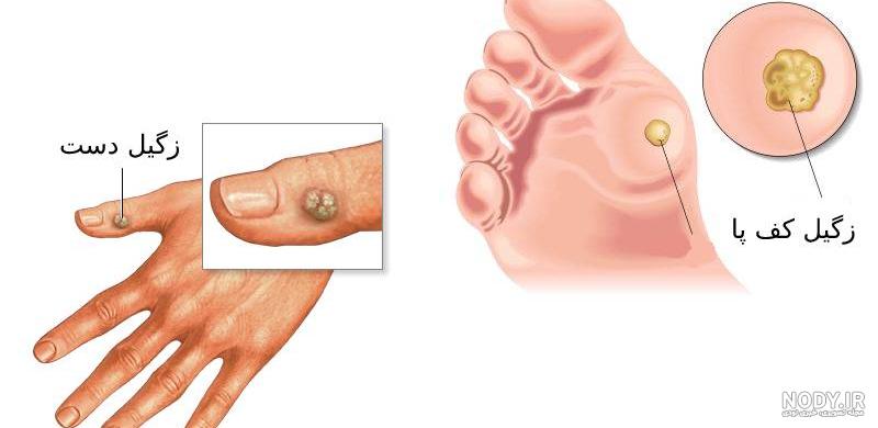 زگیل تناسلی چیست؟ راه های انتقال و تشخیص انواع زگیل + علائم - کلینیک مهنا