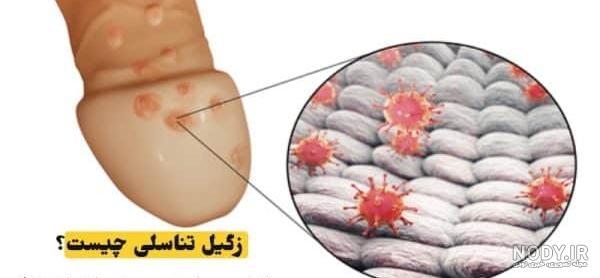 عکس از انواع زگیل