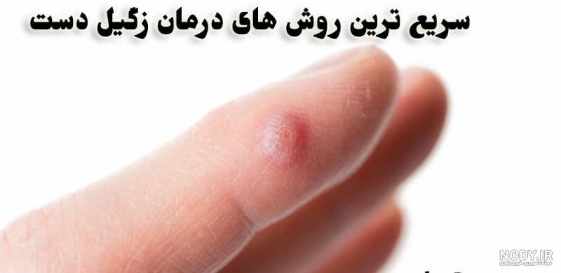 عکس از انواع زگیل تناسلی