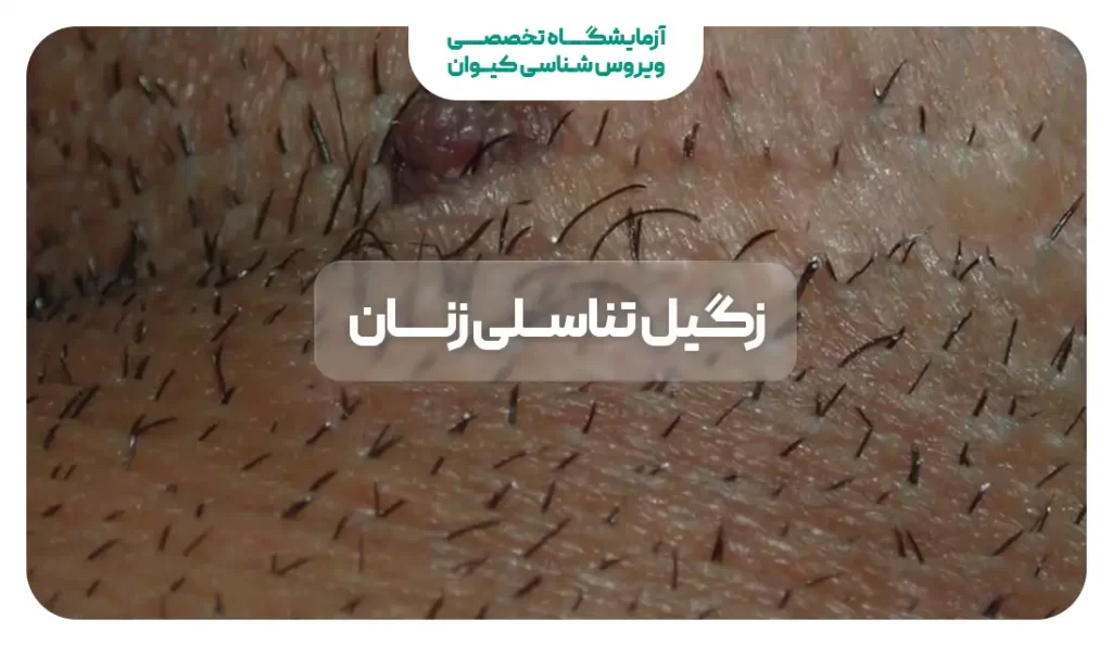 عکس از انواع زگیل تناسلی زنان