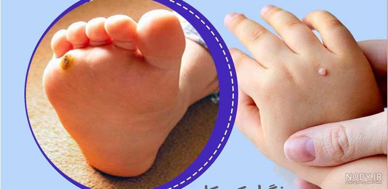 عکس از انواع زگیل تناسلی مردان