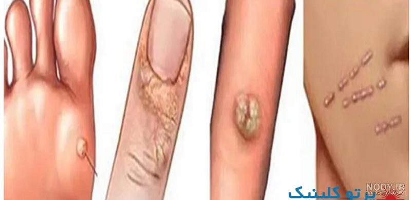 عکس انواع زگیل تناسلی